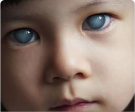 Glaucoma Congenito